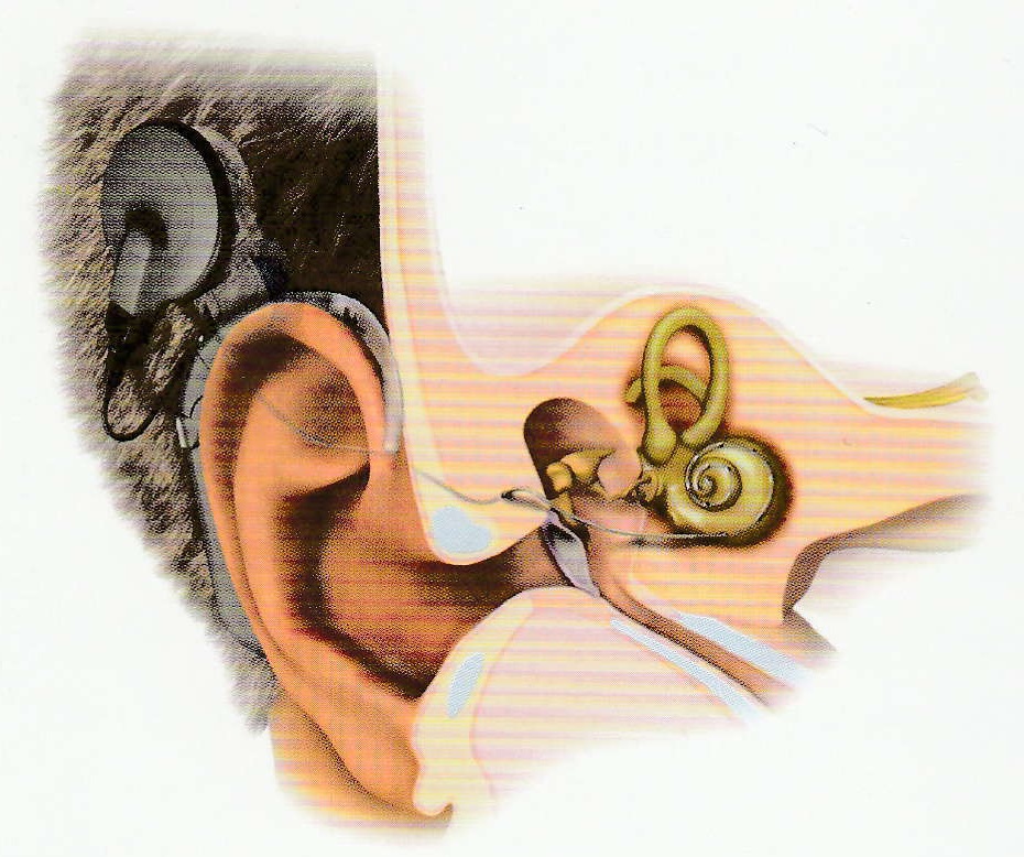 人工耳蜗常见问答